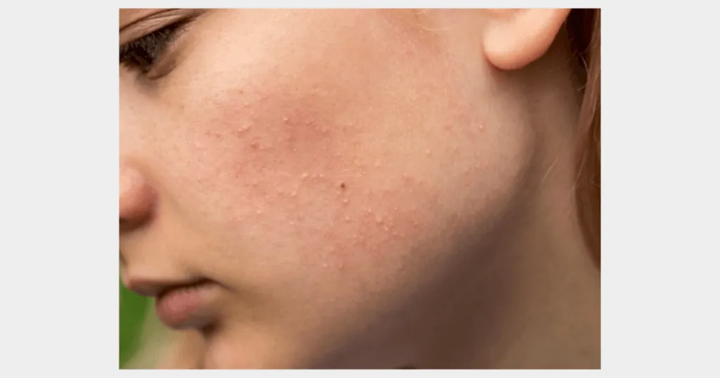 Efek Samping Fair and Lovely Yang Harus Kalian Ketahui! 2 efek samping fair and lovely